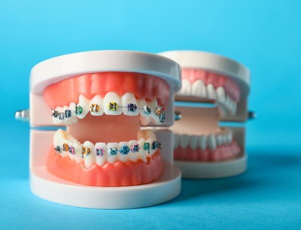 ortodonti-tedavisi-resim-2