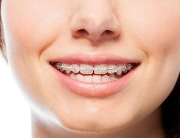 ortodonti-tedavisi-resim-3